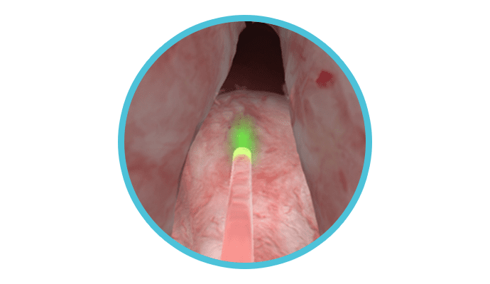 HoLEP Procedure