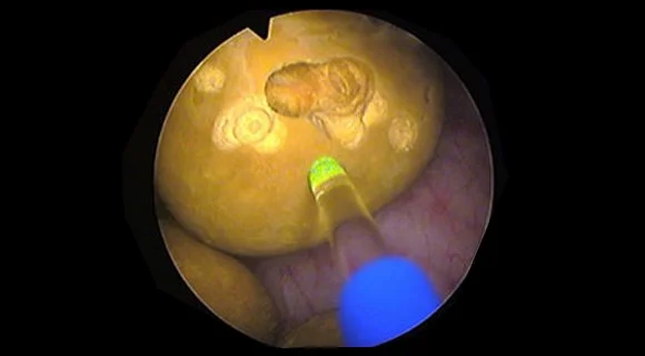 Effective in both Lithotripsy and Soft Tissue Surgery