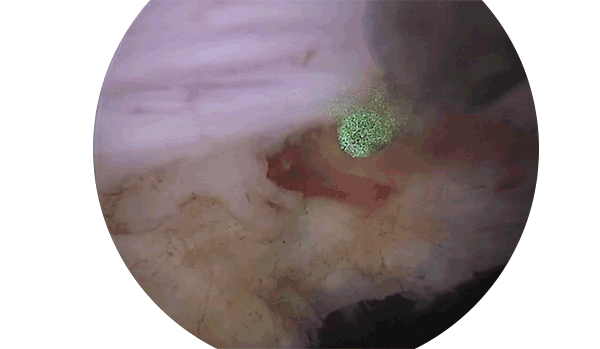 Hemostatic Effect