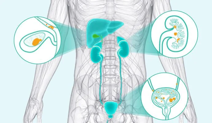 Ultimate Flexible Endoscope Stones Management
