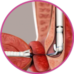 Straight Urethral Tube