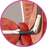 No-Retention Balloon
