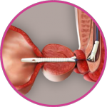 Sphincter Stability