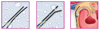Nitinol Core Technology Diagram